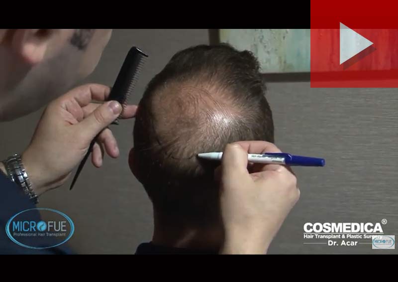 segundo_trasplante_injerto_capilar_Turquia_Microfue