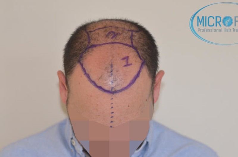 Trasplante capilar en turquia Trasplante capilar en turquia