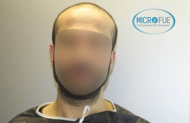 imágenes resultados trasplante capilar Turquía Microfue 01_1 imágenes resultados trasplante capilar Turquía Microfue 01_1