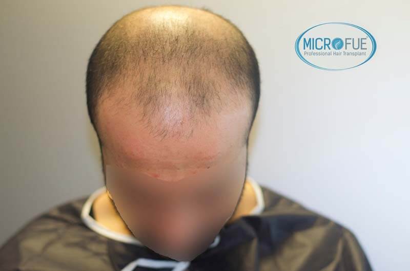 imágenes resultados trasplante capilar Turquía Microfue 01_2 imágenes resultados trasplante capilar Turquía Microfue 01_2