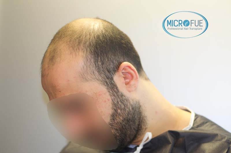 imágenes resultados trasplante capilar Turquía Microfue 01_3 imágenes resultados trasplante capilar Turquía Microfue 01_3