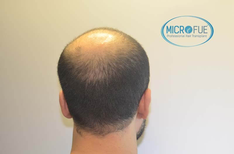 imágenes resultados trasplante capilar Turquía Microfue 01_4 imágenes resultados trasplante capilar Turquía Microfue 01_4