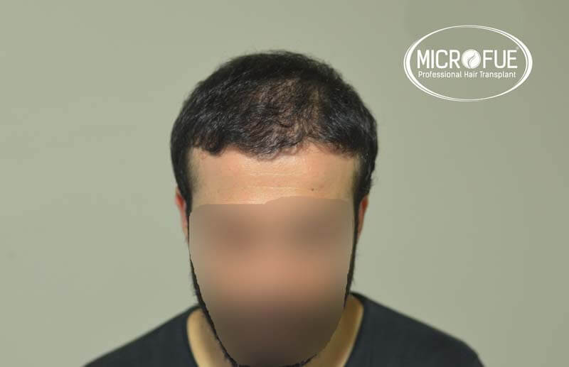 imágenes resultados trasplante capilar Turquía Microfue 01_5 imágenes resultados trasplante capilar Turquía Microfue 01_5
