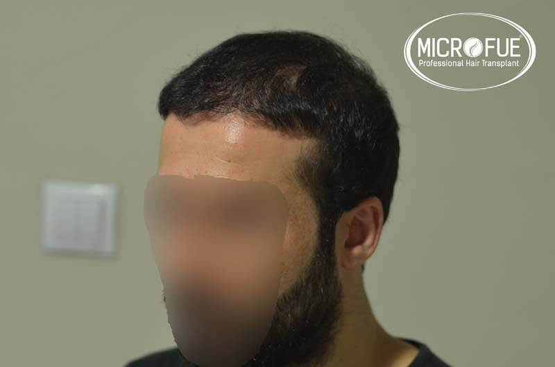 imágenes resultados trasplante capilar Turquía Microfue 01_7 imágenes resultados trasplante capilar Turquía Microfue 01_7