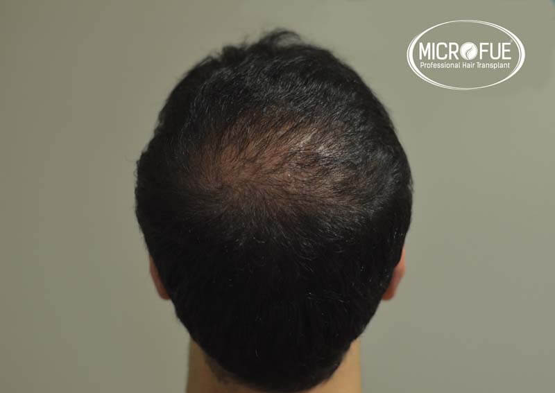 imágenes resultados trasplante capilar Turquía Microfue 01_8 imágenes resultados trasplante capilar Turquía Microfue 01_8