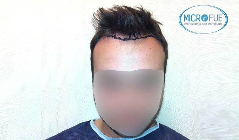 resultados_fotos_injerto_trasplante_capilar_turquia_microfue_5_02 resultados_fotos_injerto_trasplante_capilar_turquia_microfue_5_02