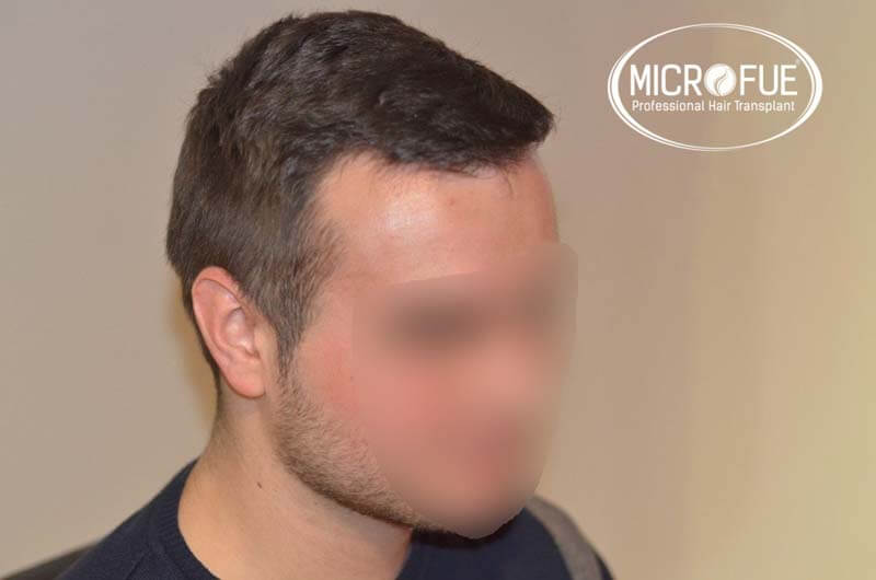 resultados_fotos_injerto_trasplante_capilar_turquia_microfue_5_04 resultados_fotos_injerto_trasplante_capilar_turquia_microfue_5_04