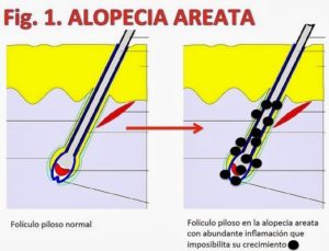 Alopecia Areata