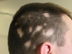 alopecia_areata_tratamiento_trasplante_capilar