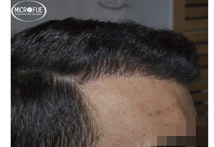 foto trasplante pelo microfue foto trasplante pelo microfue
