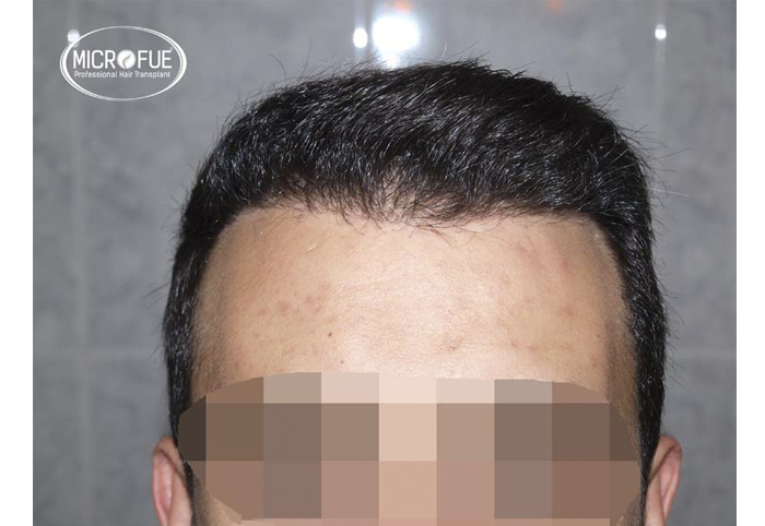 foto trasplante pelo microfue foto trasplante pelo microfue