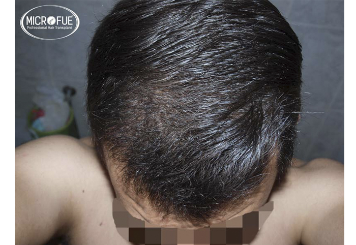 foto trasplante pelo microfue foto trasplante pelo microfue