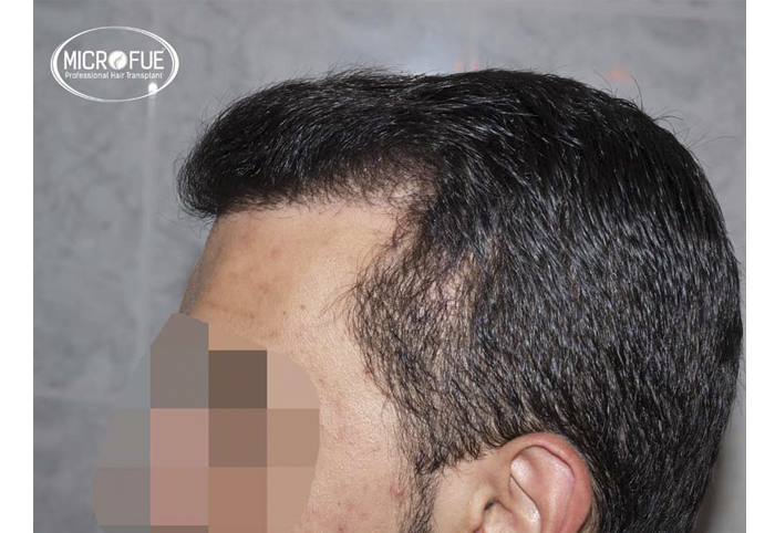 foto trasplante pelo microfue foto trasplante pelo microfue