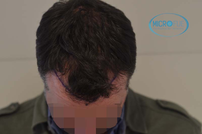 Antes y después de trasplante capilar en Turquía - Microfue Antes y después de trasplante capilar en Turquía - Microfue