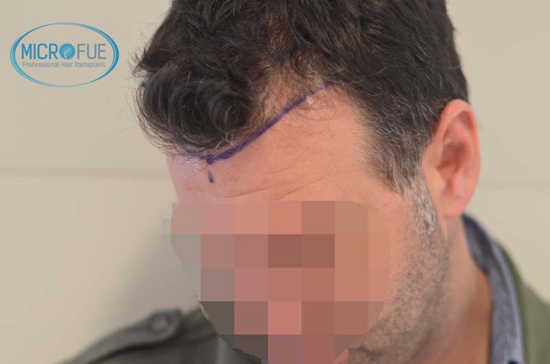 Antes y después de trasplante capilar en Turquía - Microfue Antes y después de trasplante capilar en Turquía - Microfue