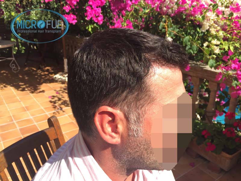 Antes y después de trasplante capilar en Turquía - Microfue Antes y después de trasplante capilar en Turquía - Microfue