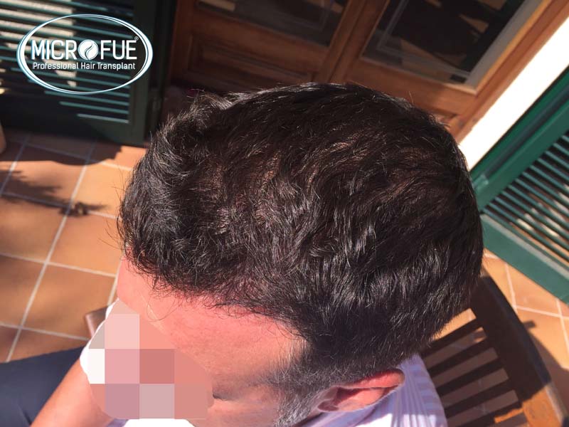 Antes y después de trasplante capilar en Turquía - Microfue Antes y después de trasplante capilar en Turquía - Microfue