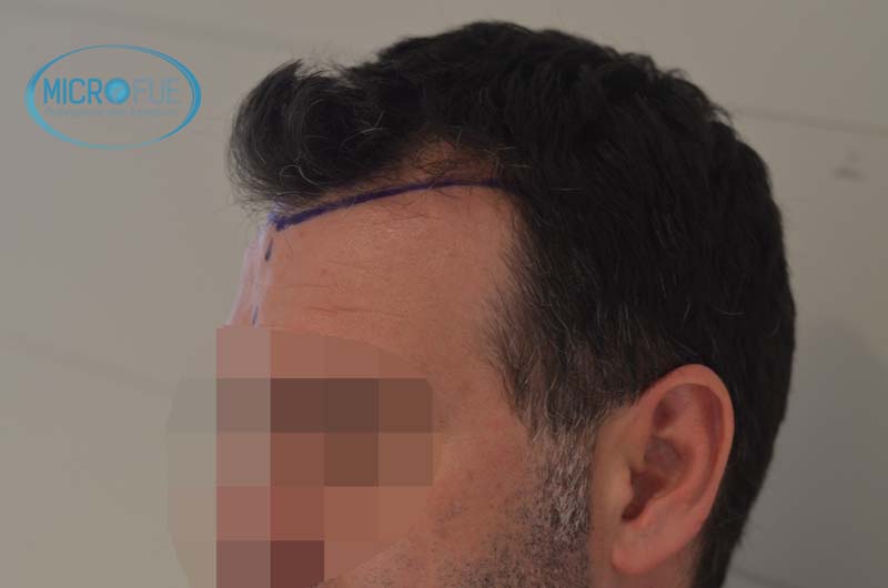 Antes y después de trasplante capilar en Turquía - Microfue Antes y después de trasplante capilar en Turquía - Microfue