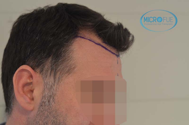 Antes y después de trasplante capilar en Turquía - Microfue Antes y después de trasplante capilar en Turquía - Microfue
