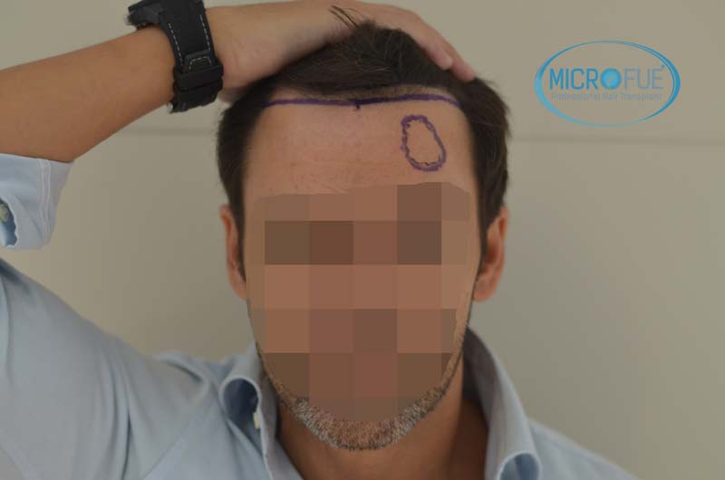 antes y despues de implante de pelo solo en entradas antes y despues de implante de pelo solo en entradas