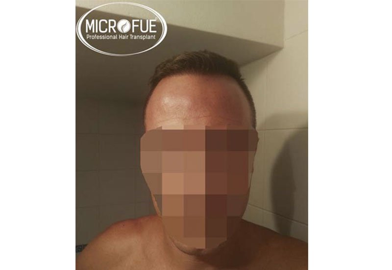 Trasplante capilar con Microfue Trasplante capilar con Microfue