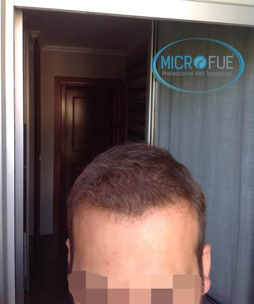 injerto_capilar_en_turquia injerto_capilar_en_turquia