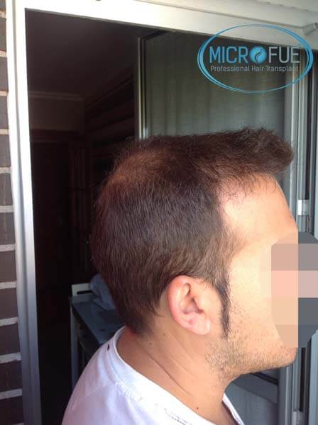 injerto_capilar_en_turquia injerto_capilar_en_turquia