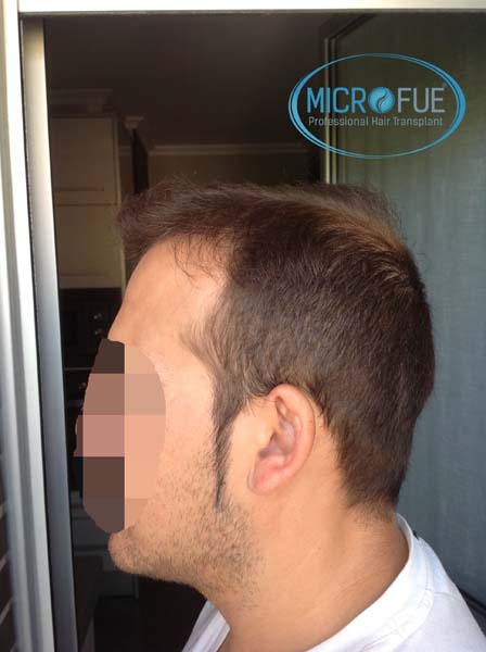injerto_capilar_en_turquia injerto_capilar_en_turquia
