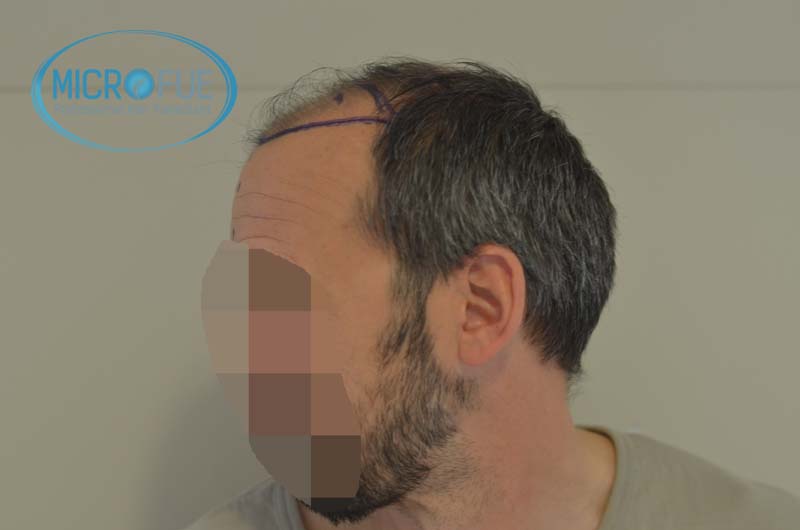 injerto_de_pelo-10 injerto_de_pelo-10