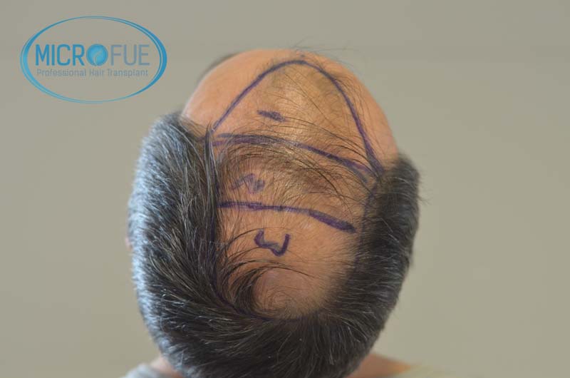 injerto_de_pelo-12 injerto_de_pelo-12