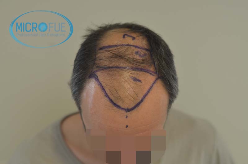 injerto_de_pelo-14 injerto_de_pelo-14