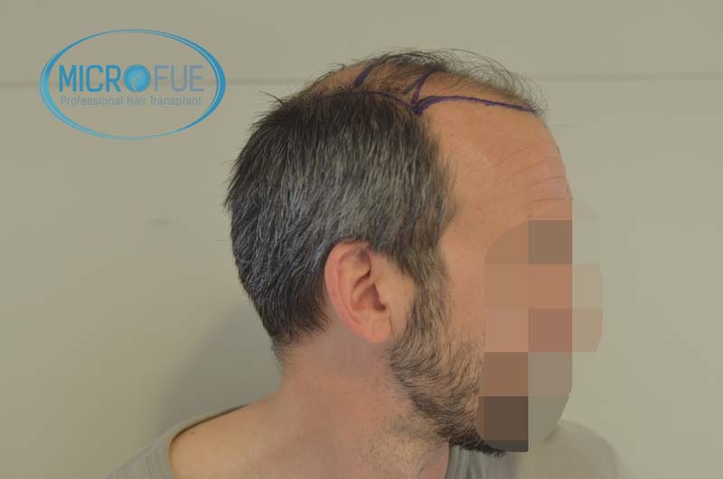 injerto_de_pelo-15 injerto_de_pelo-15