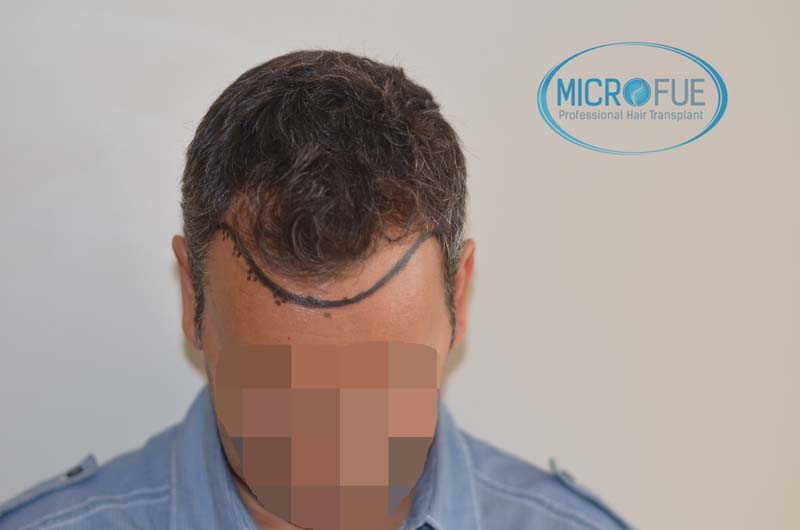 foto trasplante pelo microfue foto trasplante pelo microfue