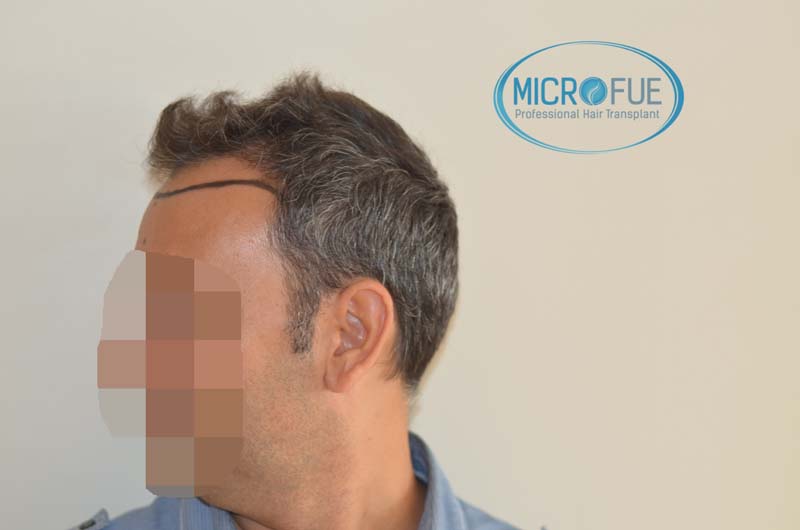 trasplante pelo microfue trasplante pelo microfue