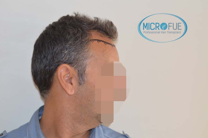 foto trasplante pelo microfue foto trasplante pelo microfue