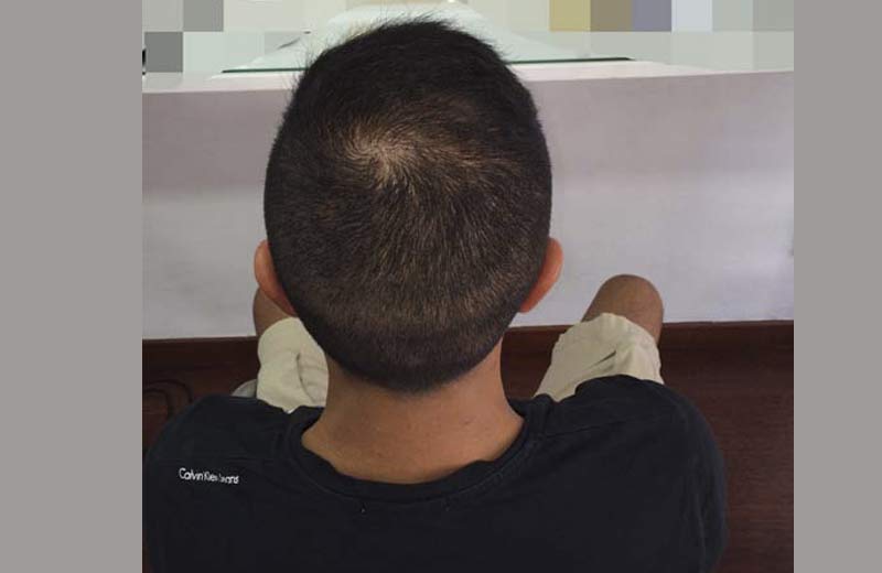 Antes y después de trasplante de pelo en turquia Antes y después de trasplante de pelo en turquia
