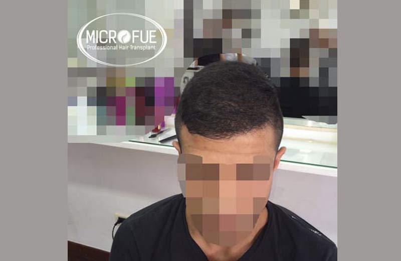 Antes y después de trasplante de pelo en turquia Antes y después de trasplante de pelo en turquia