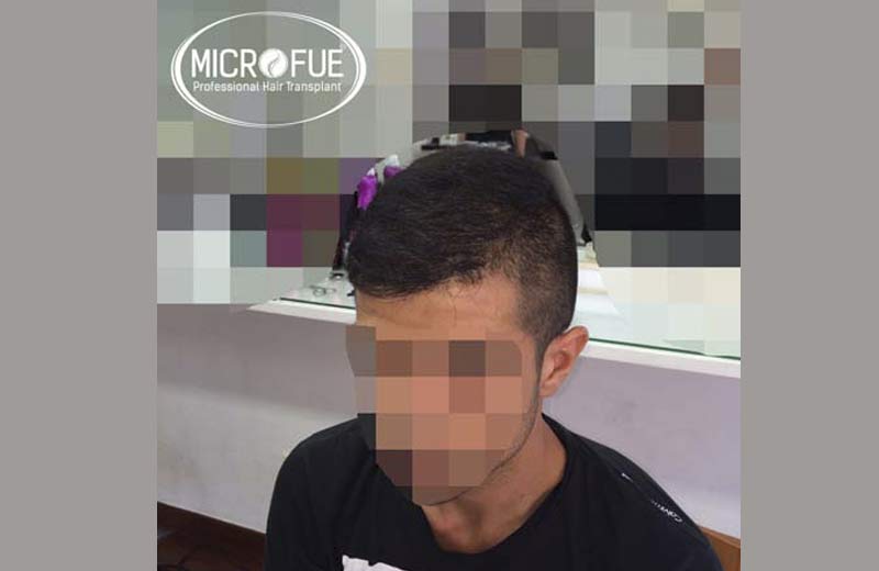 Antes y después de trasplante de pelo en turquia Antes y después de trasplante de pelo en turquia