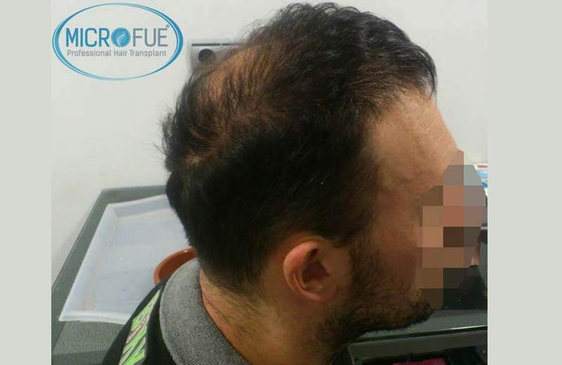 resultados_injerto_capilar_trasplante_Turquia resultados_injerto_capilar_trasplante_Turquia