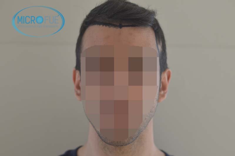 foto trasplante pelo microfue foto trasplante pelo microfue