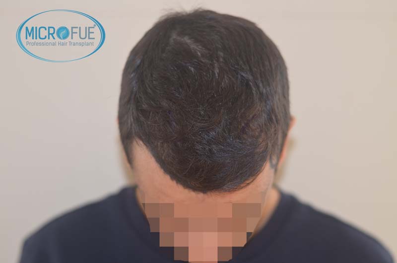 foto trasplante pelo microfue foto trasplante pelo microfue