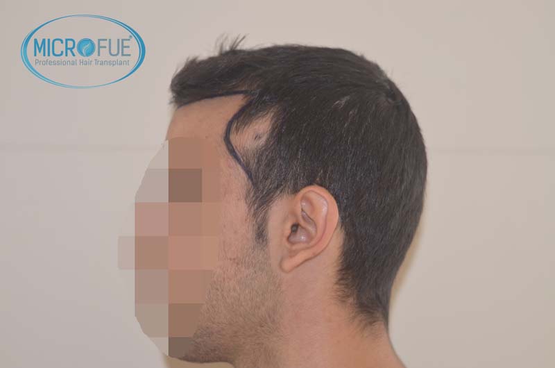 foto trasplante pelo microfue foto trasplante pelo microfue