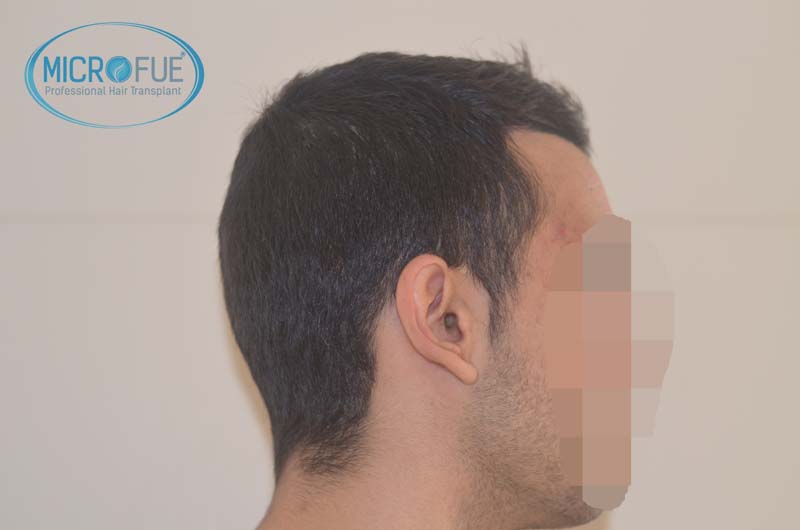 foto trasplante pelo microfue foto trasplante pelo microfue