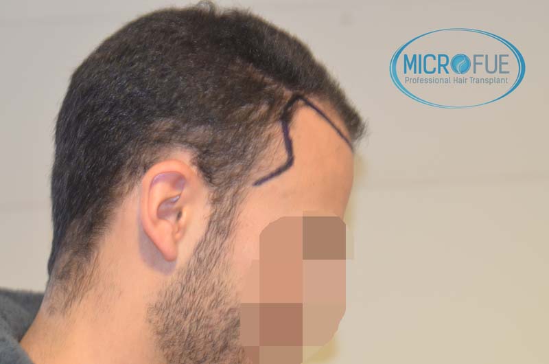 trasplante_microfue-14 trasplante_microfue-14