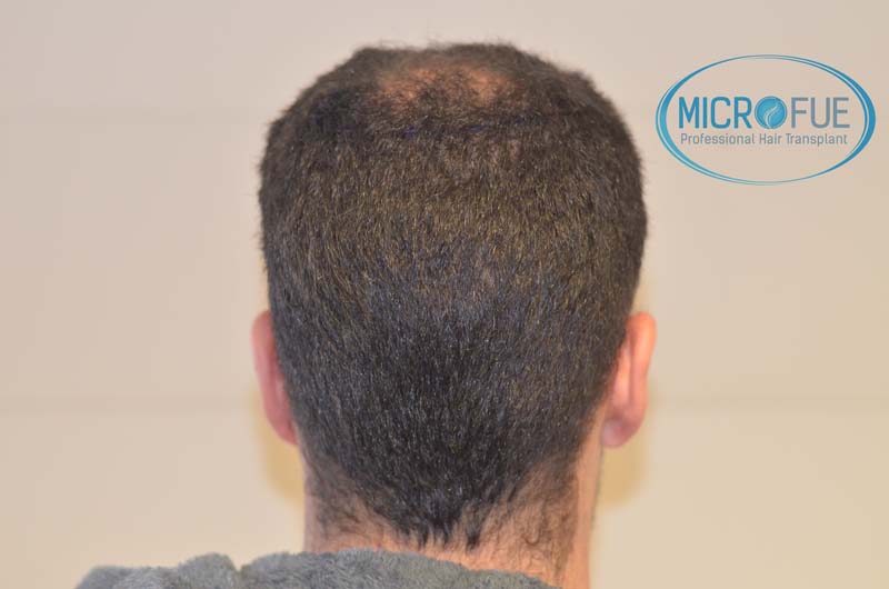 trasplante_microfue-15 trasplante_microfue-15