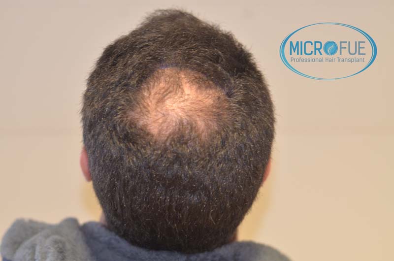 trasplante_microfue-16 trasplante_microfue-16