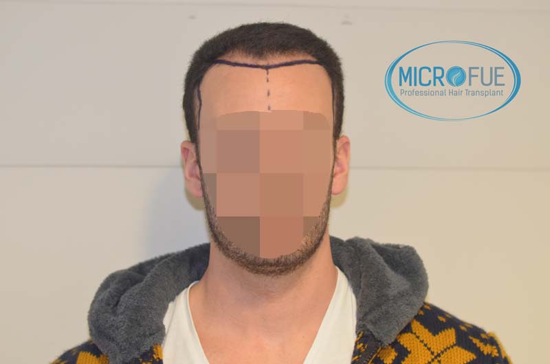 trasplante_microfue-17 trasplante_microfue-17