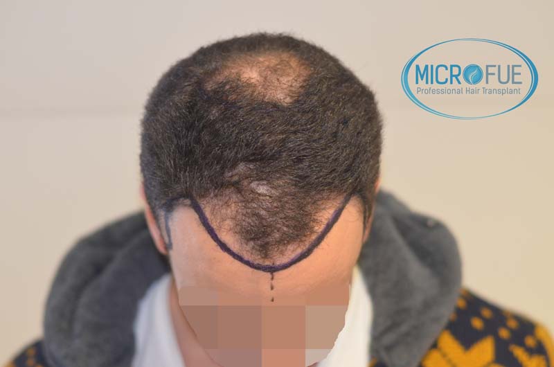 trasplante_microfue-18 trasplante_microfue-18