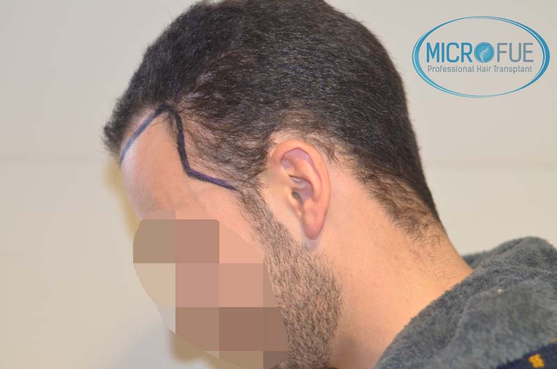 trasplante_microfue-19 trasplante_microfue-19
