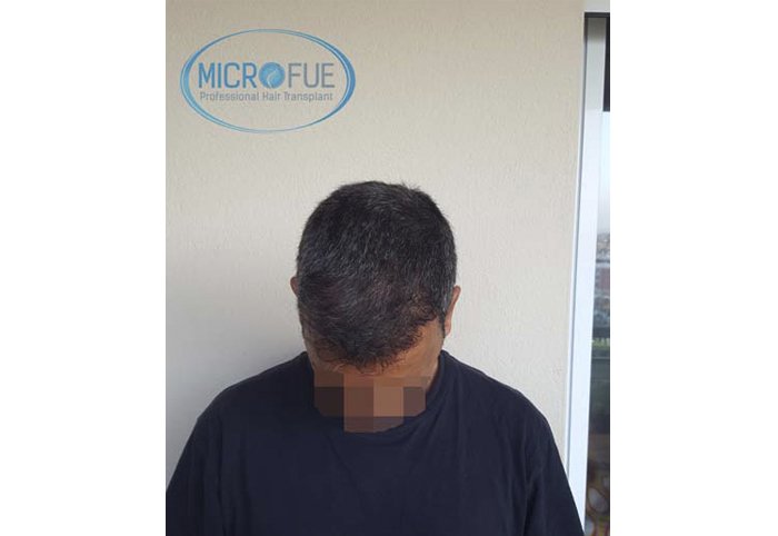 foto trasplante pelo microfue foto trasplante pelo microfue